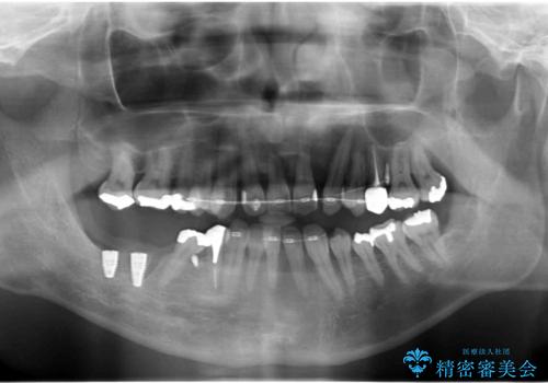 受け口 なんと部分矯正で治るんです!! インプラントを含めた総合歯科治療の治療中