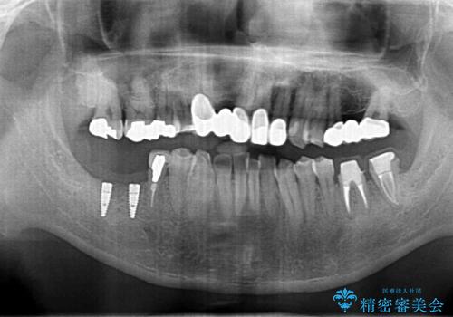 短期間で歯並びをきれいにしたい セラミックでかぶせる治療でも良いの治療中