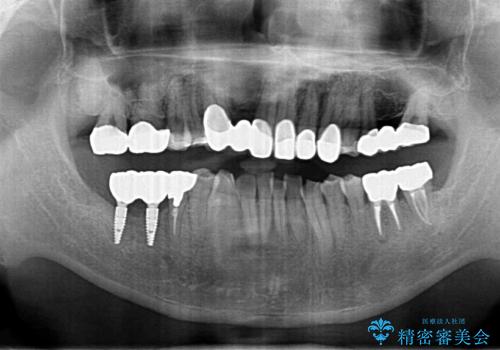 短期間で歯並びをきれいにしたい セラミックでかぶせる治療でも良いの治療後