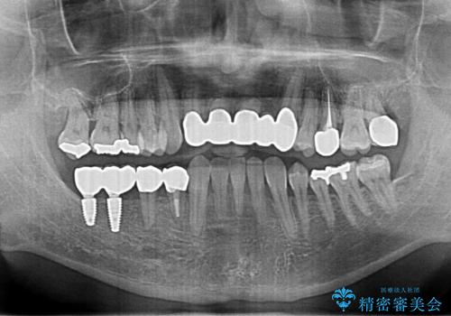 受け口 なんと部分矯正で治るんです!! インプラントを含めた総合歯科治療の治療後