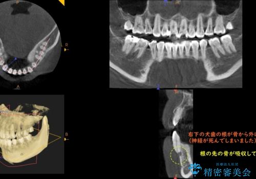 他院で矯正後、歯の神経が死んでしまった歯の治療 の治療前
