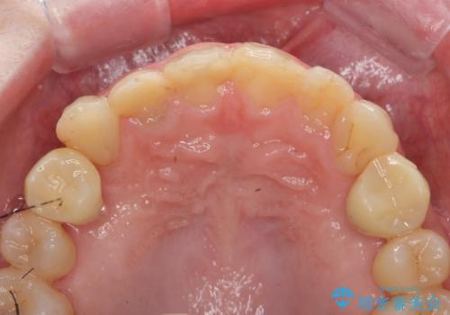 多発した前歯の重度虫歯治療の治療中
