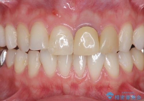 前歯の見た目を改善 セラミック審美治療の治療前