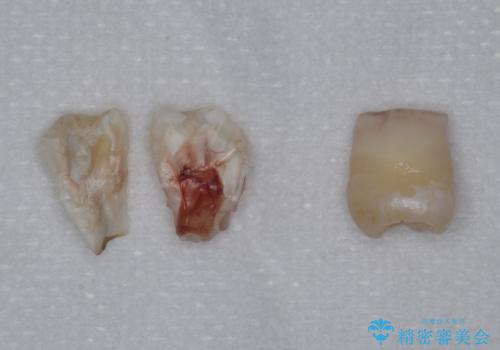 親知らずを抜きたいの治療中