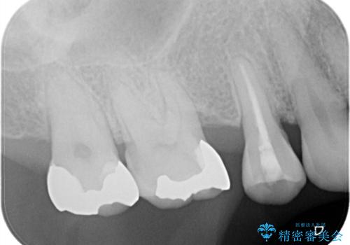 【セラミッククラウン】インレーが外れた。の治療前