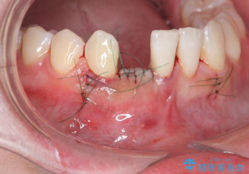 [ 先天性の前歯欠損 ]　矯正とインプラントの包括治療の治療中