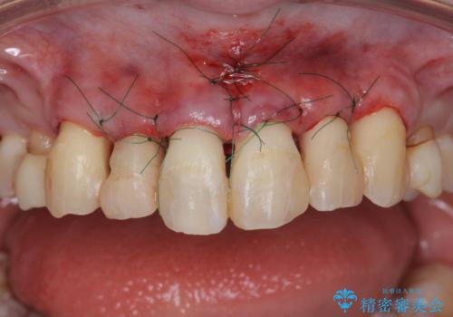多発した前歯の重度虫歯治療の治療中