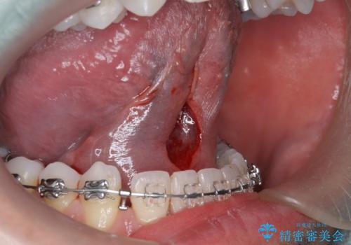 舌小帯の切除の治療中