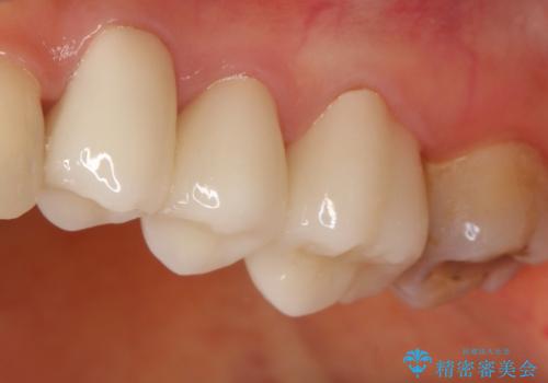 【オールセラミッククラウン】銀歯の下に大きな虫歯の治療後