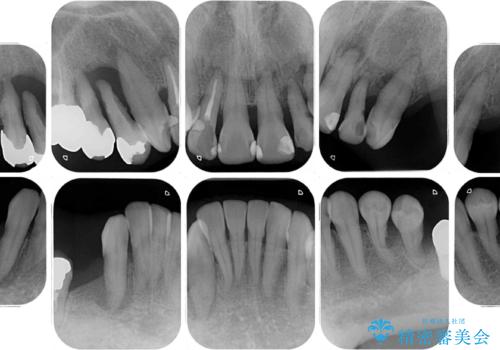 歯周病で痛い 全顎的歯周病治療の治療前