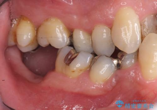 受け口 なんと部分矯正で治るんです!! インプラントを含めた総合歯科治療の治療前