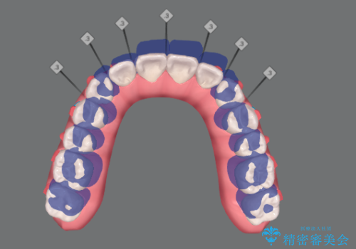 歯を抜かずに後方移動で達成する、前突感の改善