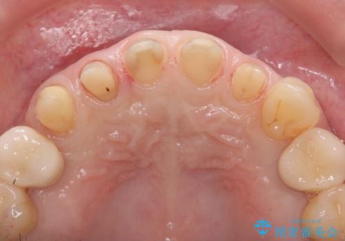 多発した前歯の重度虫歯治療の治療中
