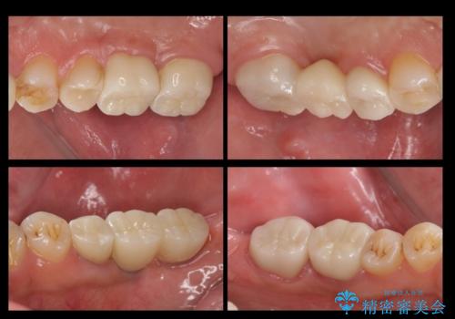 短期間で歯並びをきれいにしたい セラミックでかぶせる治療でも良いの治療後