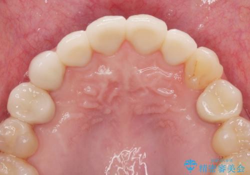 多発した前歯の重度虫歯治療の治療後