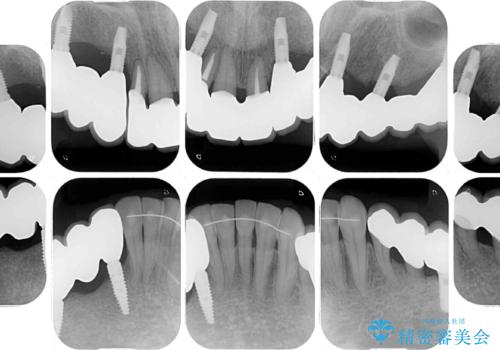 歯周病で痛い　全顎的歯周病治療の治療後