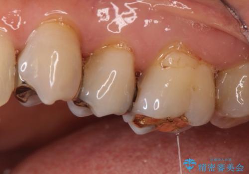 【オールセラミッククラウン】銀歯の下に大きな虫歯の治療前