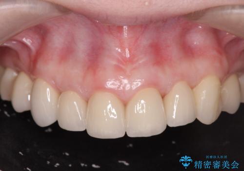 多発した前歯の重度虫歯治療の症例 治療後