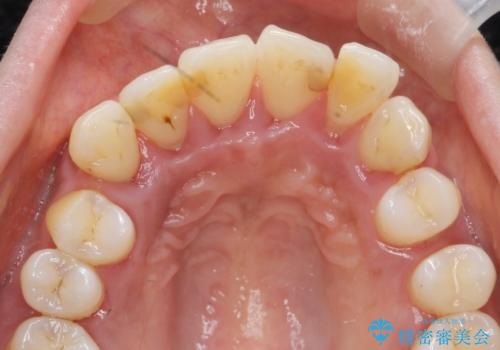 [ 再生治療・歯周外科・小矯正・セラミック補綴 ]  前歯の歯周病治療の治療前