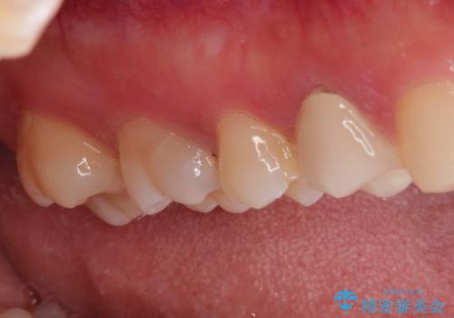 【VPT(歯髄温存療法)とセラミックインレー】深い虫歯でも神経を残したいの治療前