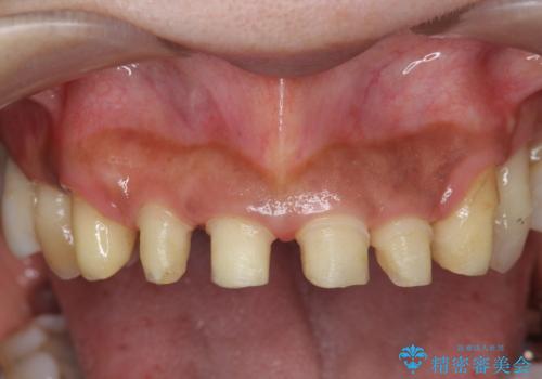 [ 再生治療・歯周外科・小矯正・セラミック補綴 ]  前歯の歯周病治療の治療中