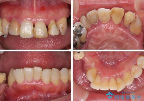 歯周病で痛い 全顎的歯周病治療の治療前