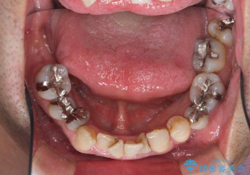 受け口 なんと部分矯正で治るんです!! インプラントを含めた総合歯科治療の治療前