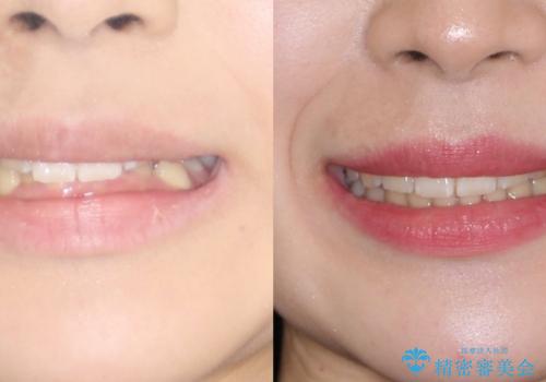 【審美ワイヤー】前歯が見えない。深い噛み合わせの治療