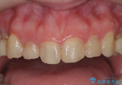 多発した前歯の重度虫歯治療の治療中