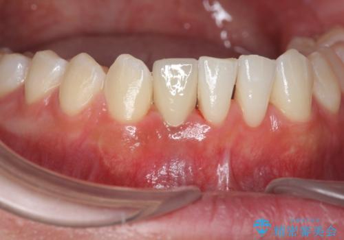 [ 先天性の前歯欠損 ]　矯正とインプラントの包括治療の症例 治療後