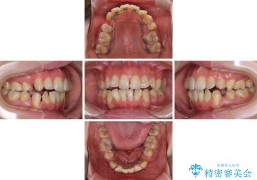 裏側矯正の途中で海外へ インビザライン・チェンジによる矯正治療の治療中