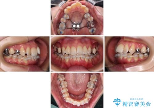 【モニター】急速拡大装置 狭い歯列を拡大してワイヤー装置で短期間治療の治療中