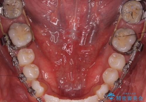 舌小帯の切除の治療後