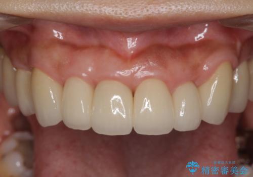 [ 再生治療・歯周外科・小矯正・セラミック補綴 ]  前歯の歯周病治療の症例 治療後
