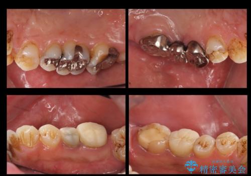 短期間で歯並びをきれいにしたい セラミックでかぶせる治療でも良いの治療前