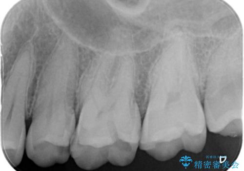 【セラミックインレー】定期検診で見つかった虫歯。の治療前