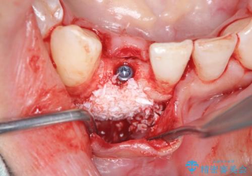 [ 先天性の前歯欠損 ]　矯正とインプラントの包括治療の治療中