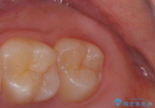 親知らずを抜きたいの治療前
