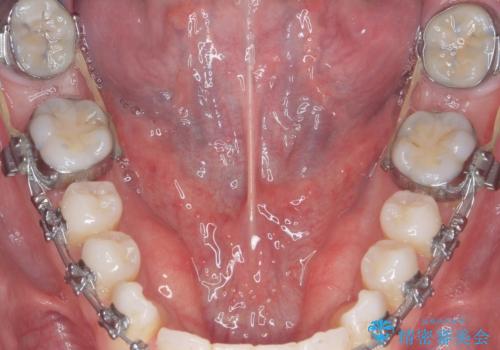 舌小帯の切除の治療前