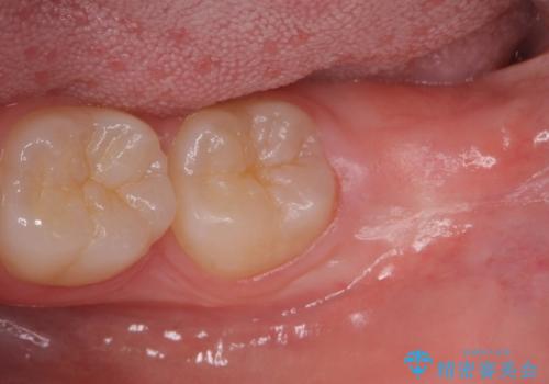 親知らずを抜きたいの治療前