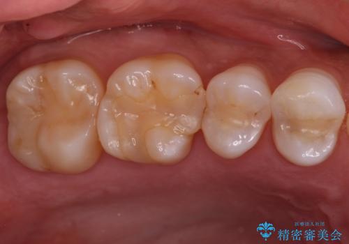 樹脂の詰め物(レジン)をセラミックに変えたいの症例 治療前