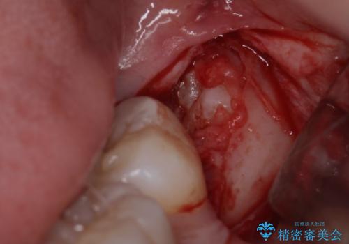 親知らずを抜きたいの治療中