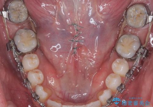 舌小帯の切除の治療中