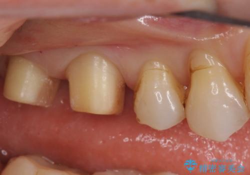 銀歯を白くしたい セラミッククラウンでの治療の治療中