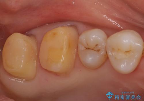 銀歯を白くしたい セラミッククラウンでの治療の治療中