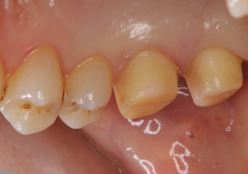銀歯を白くしたい セラミッククラウンでの治療の治療中