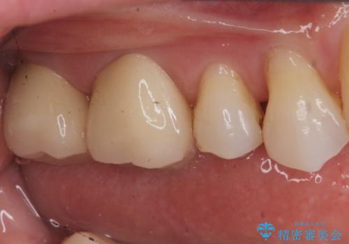 銀歯を白くしたい セラミッククラウンでの治療の治療後