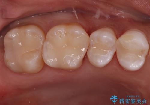 樹脂の詰め物(レジン)をセラミックに変えたいの症例 治療後