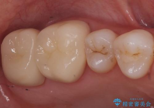 銀歯を白くしたい　セラミッククラウンでの治療の症例 治療後