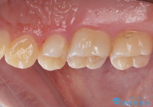 銀歯を白くしたいの治療後
